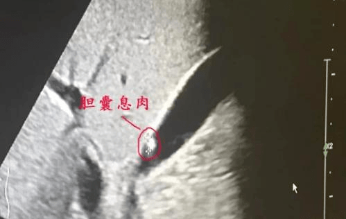 华领体检 体检查出胆囊息肉怎么办 胆囊息肉一定要切除胆囊吗 人体