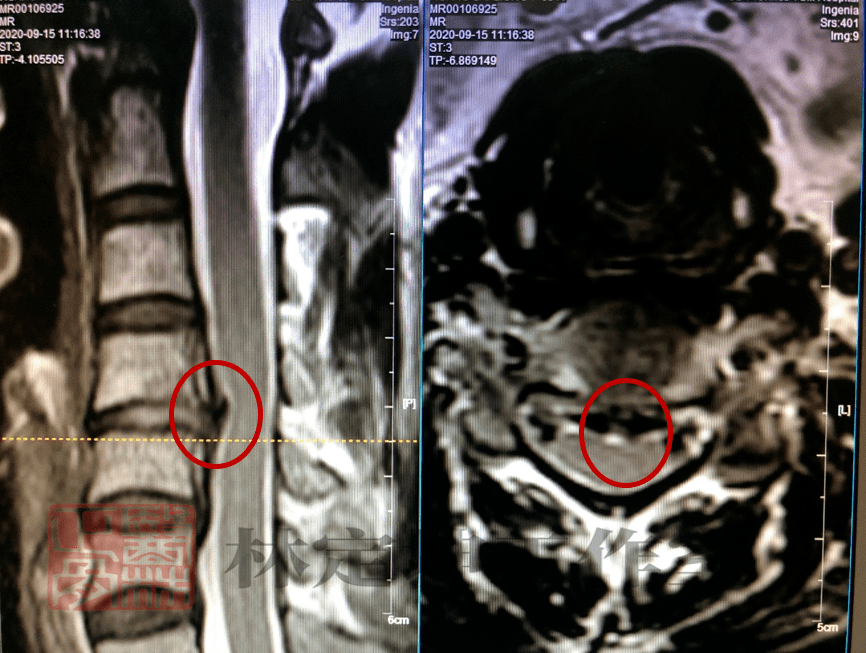 陳阿姨三個月後的頸椎磁共振檢查與前片對比,突出物明顯吸收病例聚焦