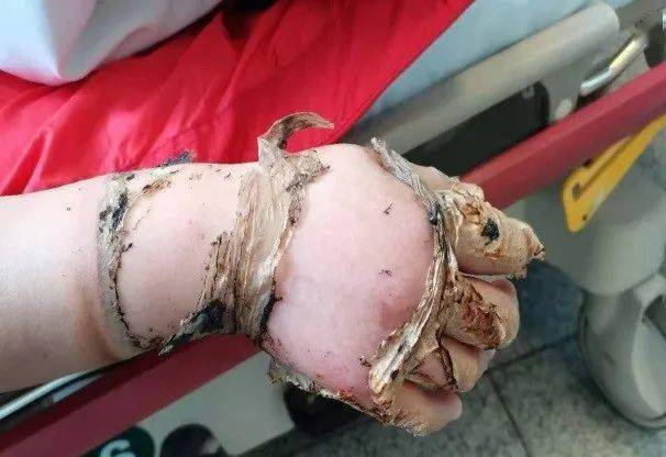 烧伤后焦痂附着在创面上可能会引发全身性的感染,王女士进行了两次