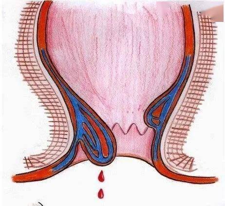 痔疮脱落出来怎么办