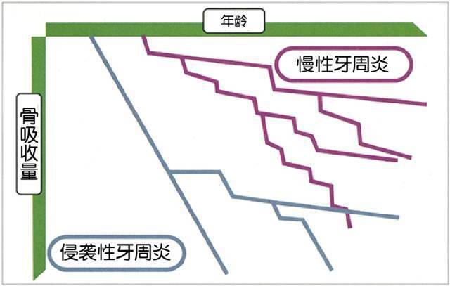 侵襲性牙周炎和慢性牙周炎的發展圖另一方面,慢性牙周炎的發病較遲