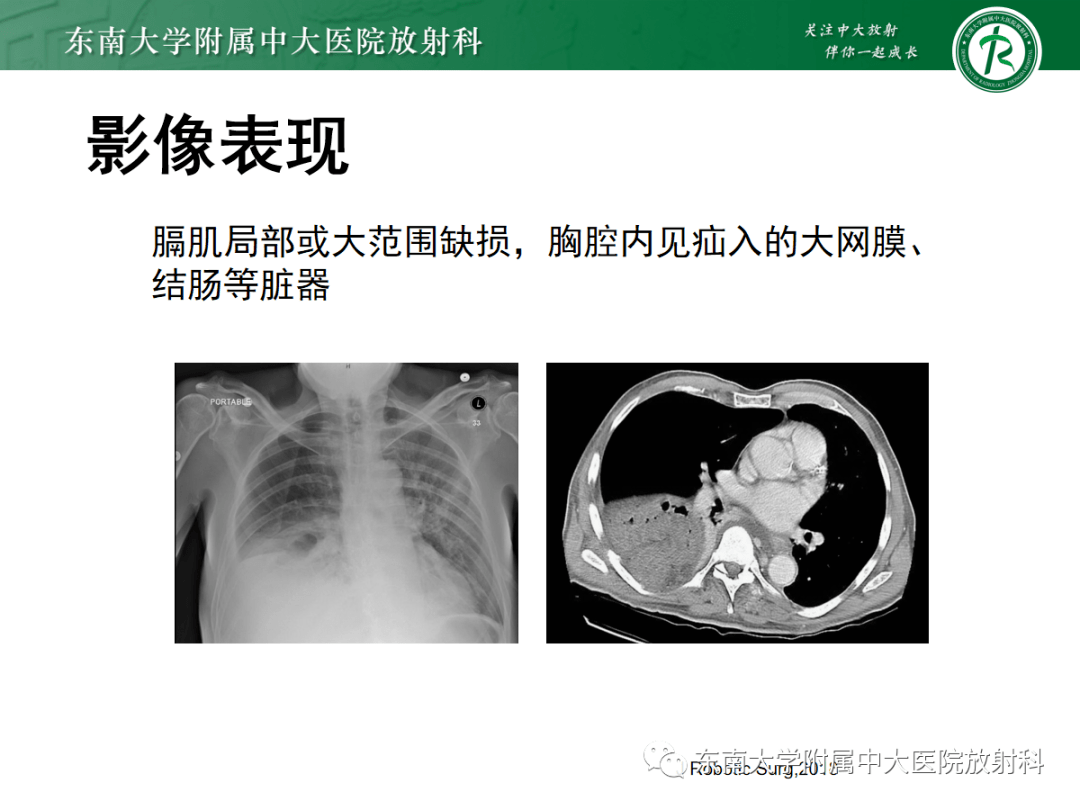 晨讀結果公佈20210526膈肌病變膈疝