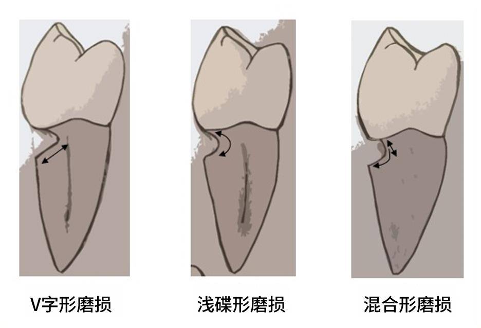 漲知識牙頸部位有豁口小心楔狀缺損把牙齒送上斷頭臺