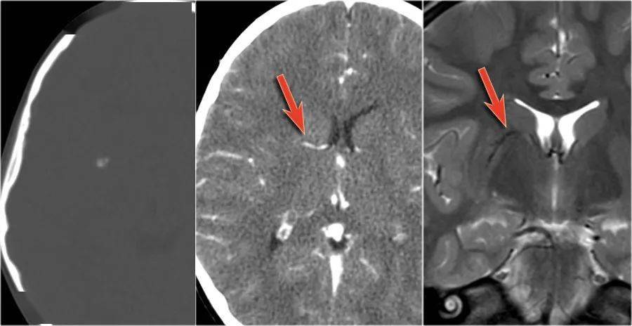 脑癫痫mri的作用三海绵状血管瘤