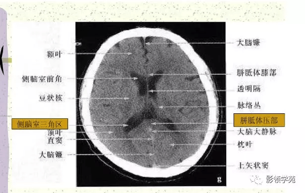 松果体,脉络丛断面解剖
