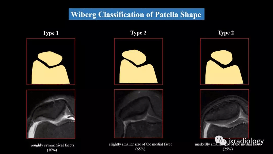 髌股关节不稳:磁共振成像综述_髌骨