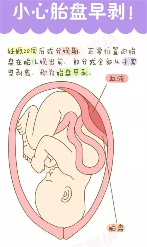 胎盘羊水子宫位置图图片