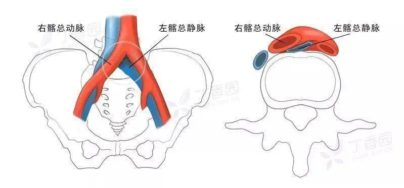 是由于髂静脉与右髂动脉,腰骶椎的特殊解剖关系,造成髂静脉长期受压