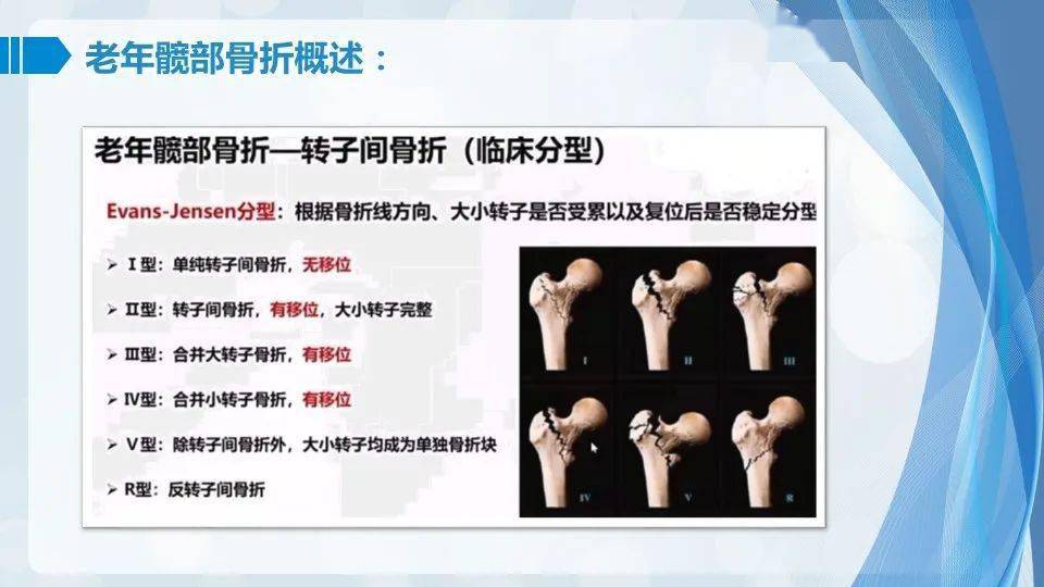 ppt案例分享一例老年髋部脆性骨折围手术期护理