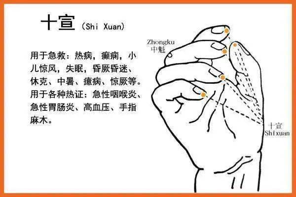 中风急救——真庆幸我在学中医,一根缝衣针救回了父亲