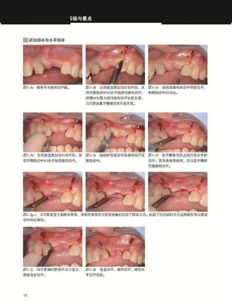 口腔种植手术中常用的外科缝合技术归纳总结  口腔缝合一般用几号针