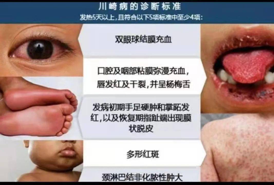 川崎病嘴巴症状图片图片