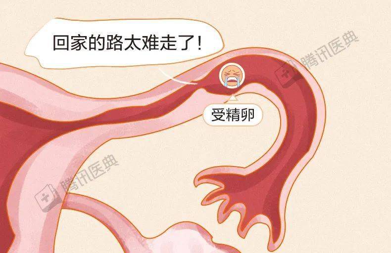 "要命"的宫外孕,最爱找这4种人_输卵管