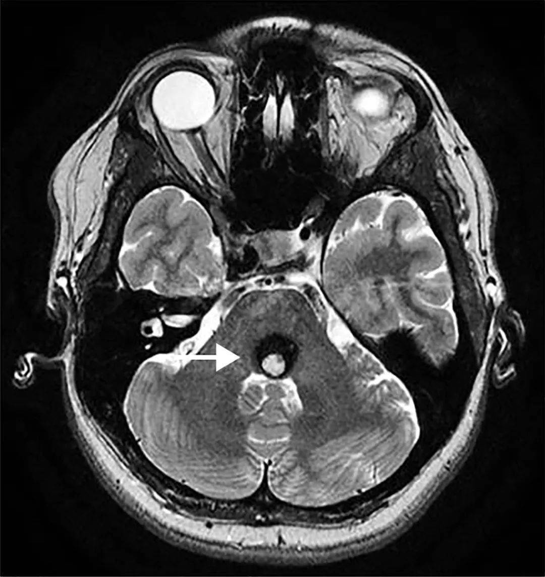 期刊精華丨neurology5月刊腦幹海綿狀血管瘤sah患者的疼痛管理社會