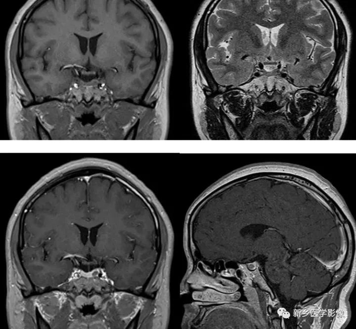 垂体瘤核磁共振图片图片