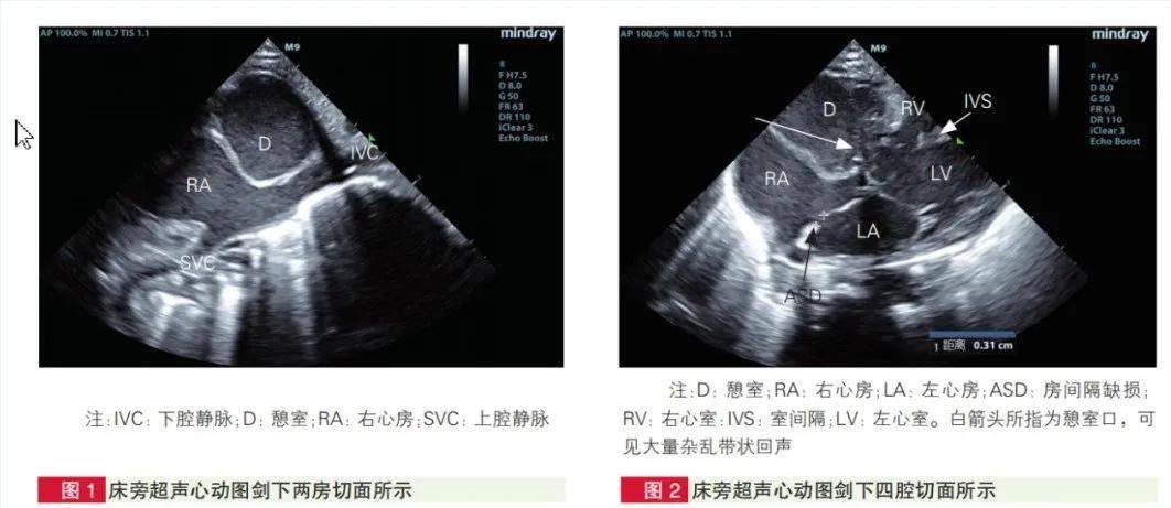 右前下两部分,左后上部分连接上,下腔静脉(图 1),右前下部分通过"三尖