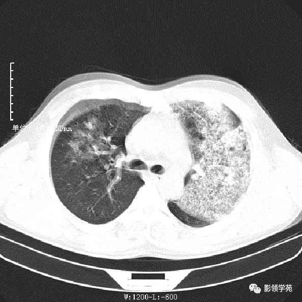 军团菌肺炎的影像诊断