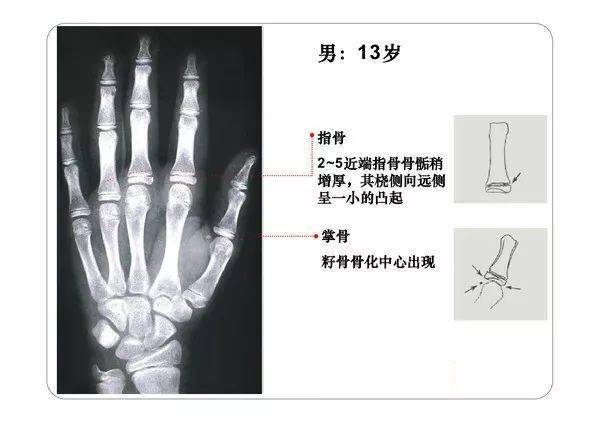 各年龄段的骨骼线图图片