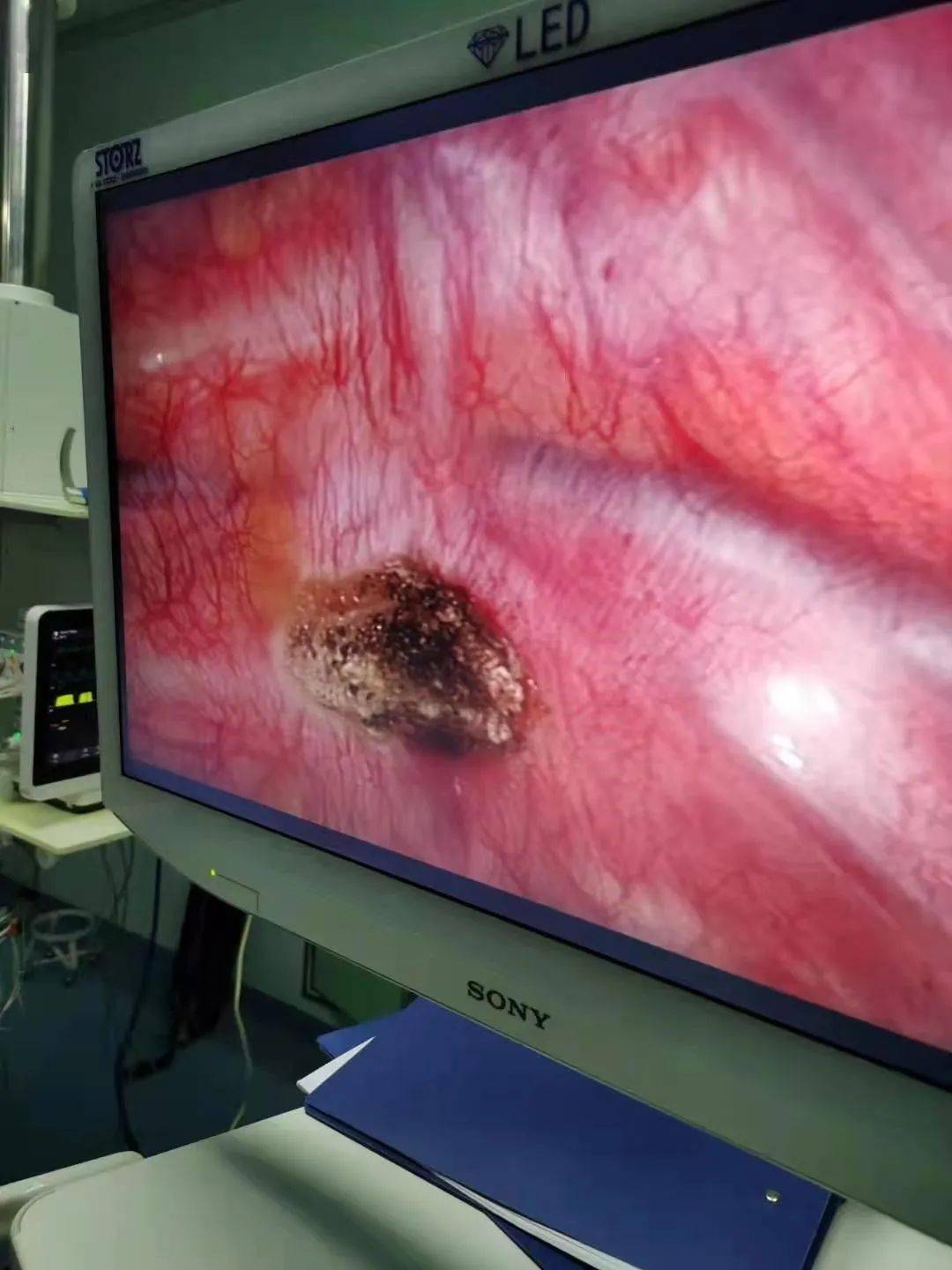 半小时治愈手汗症安阳地区医院心胸外二科腔镜微创手术