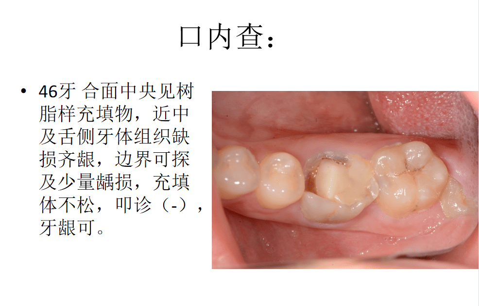 病例侧壁穿孔修补irootbpplus的应用