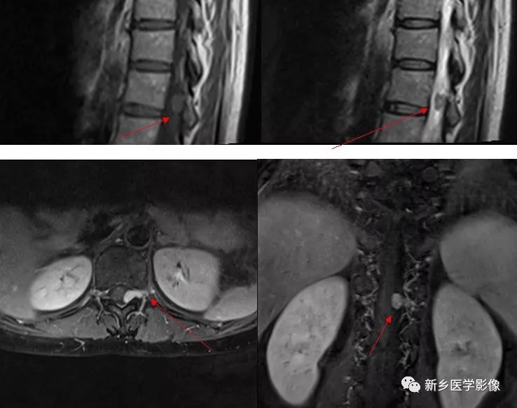 椎管内神经源性肿瘤