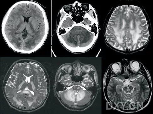 药物或毒物相关性脑白质病变