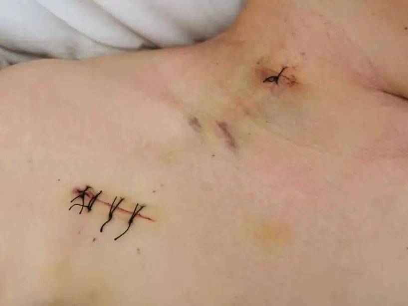 长期输液及化疗患者的福音输液港置入术