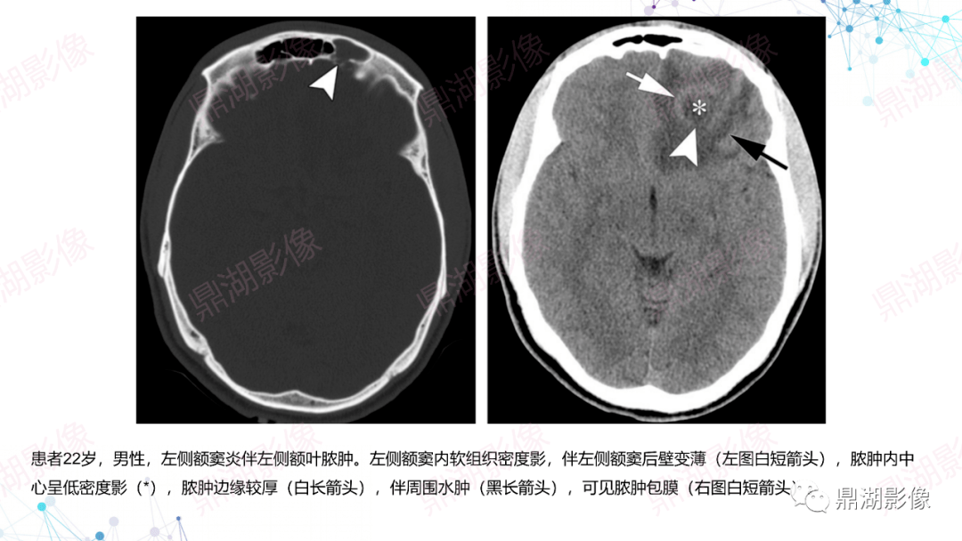 硬膜外脓肿伴帽状腱膜下蜂窝织炎海绵窦栓塞硬膜外蜂窝织炎左侧岩尖炎