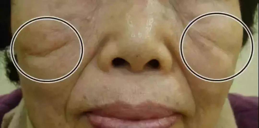 脸上出现印第安纹瞬间老10岁