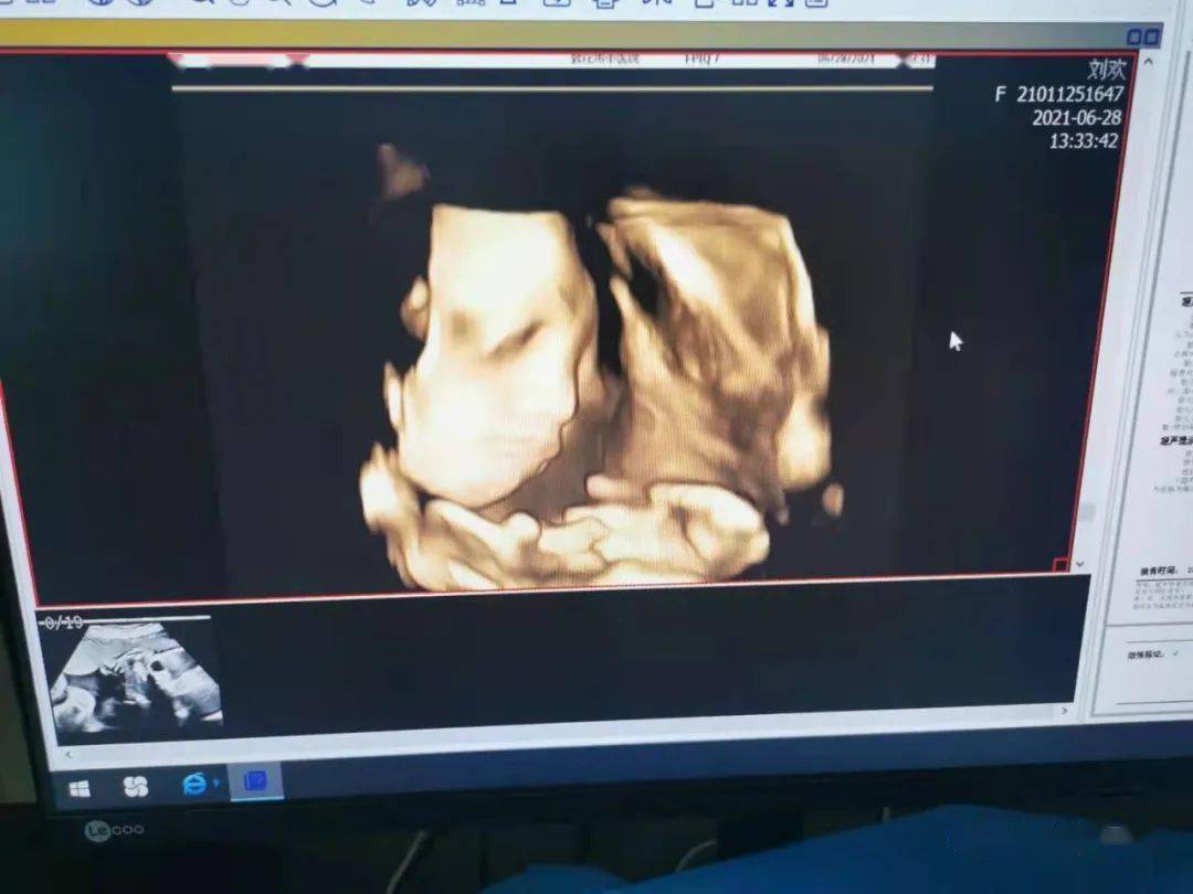 产前超声检查对胎儿有害吗？_搜狐网