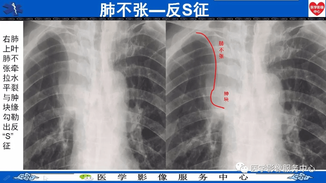 肺癌x光片表现图片