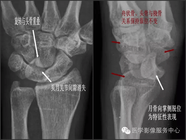 图文详解腕骨脱位_诊断