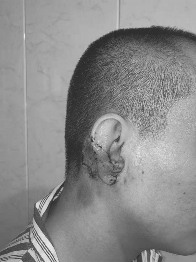 消毒|小争执后被咬半只耳，医生“残耳再造”获成功