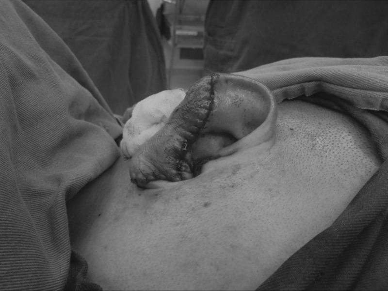 消毒|小争执后被咬半只耳，医生“残耳再造”获成功