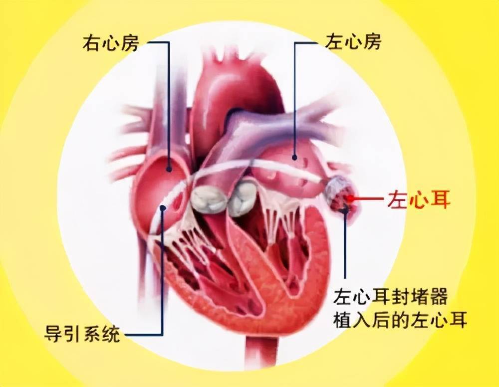 左心耳位置图片