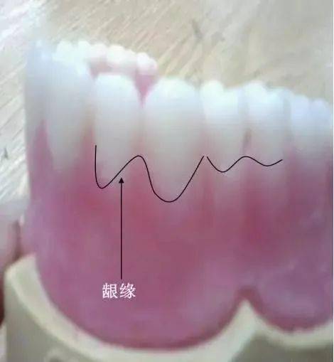 圖說全口義齒蠟型及齦溝修整要點