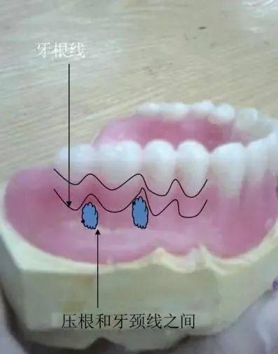 全口义齿无牙颌分区图图片