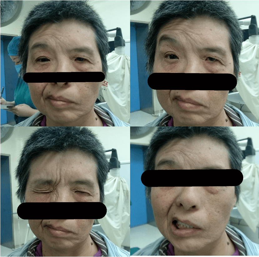 【病例分享】刁玉领博士:面舌下吻合治疗听神经瘤术后面瘫_面神经