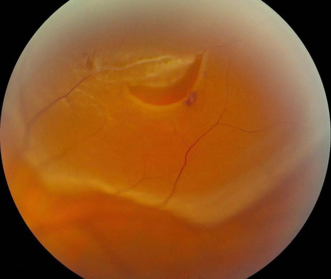 王凯医生视光课堂 | 全飞秒手术在角膜上做,为什么还要查眼底?