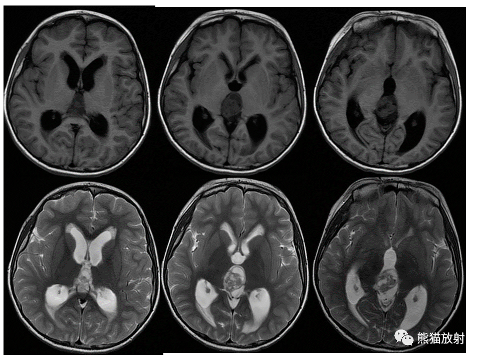 松果体层面MRI图图片