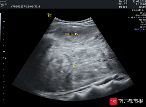 肿瘤|半年微胖8斤，长的不是肉是妇科肿瘤