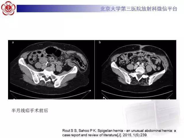半月线疝spigelian疝