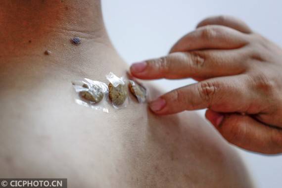 疾病|安徽黄山：“冬病夏治”正当时 三伏贴开贴