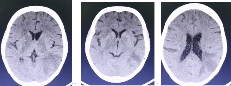 头ct示双额叶,左枕叶,双侧基底节区可见片状低密度影,左枕叶病灶