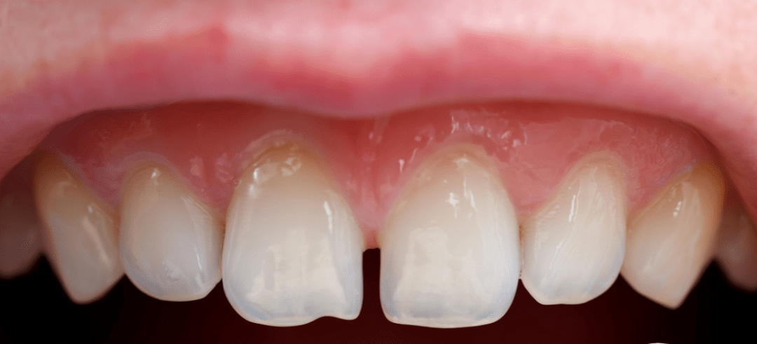 孩子门牙长成"缝隙大"怎么办?