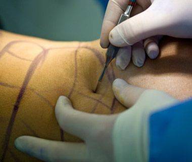 网红抽脂去世呼吁审美多元的那群人转头判白幼瘦死刑