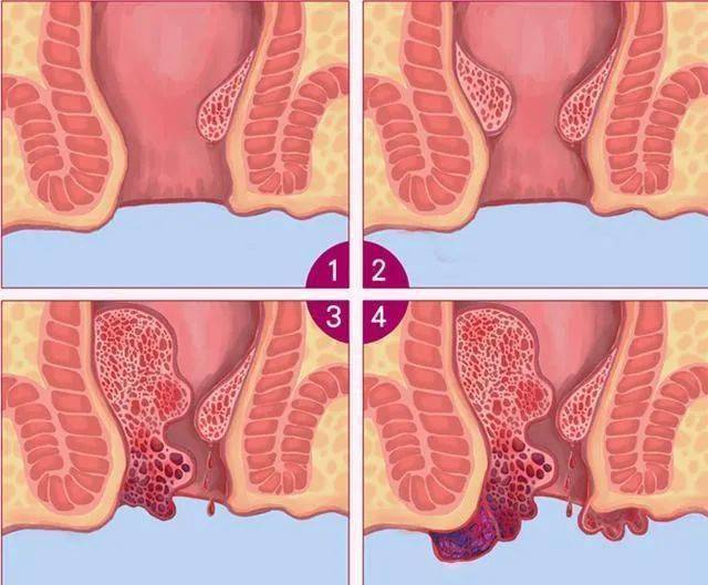 放疗后痔疮疼怎么办