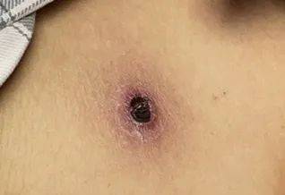 虫子|福州男子莫名发热咳嗽，竟是因这虫子…