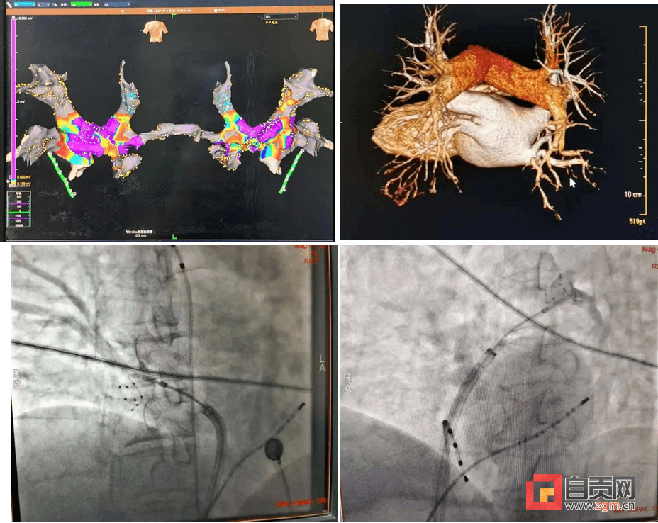 自贡一医院独立开展川南首例房颤冷冻消融术