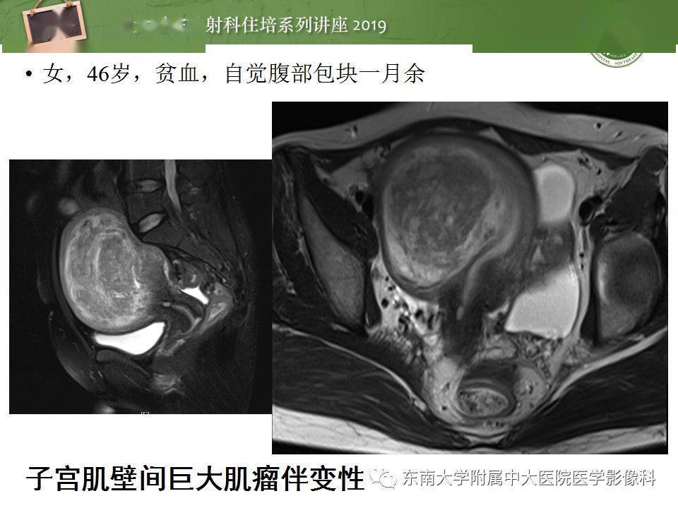 子宫详细解剖及磁共振信号分析